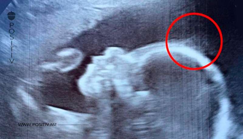 Ärzte bemerkten seltsame Konturen im Ultraschallbild. Jetzt sehen Passanten dieses Mädchen überrascht an!