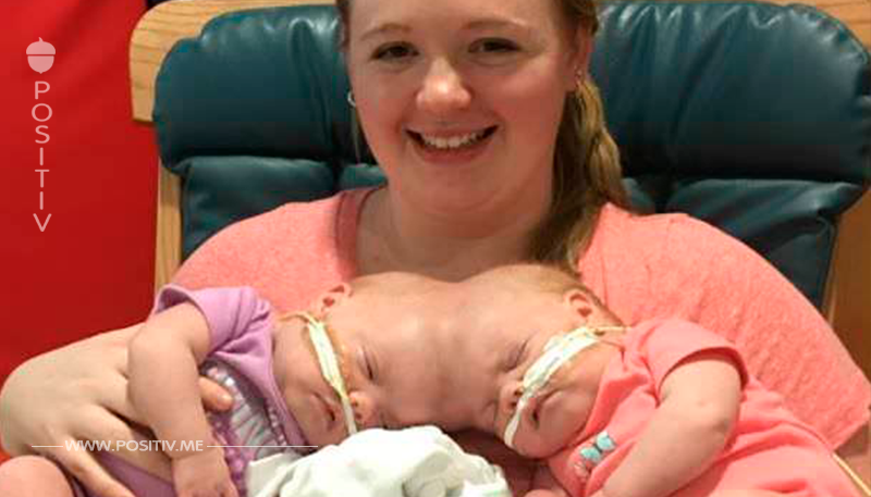Siamesische Zwillinge sind bei der Geburt am Kopf miteinander verbunden – so sehen sie zwei Jahre nach ihrer Trennung aus