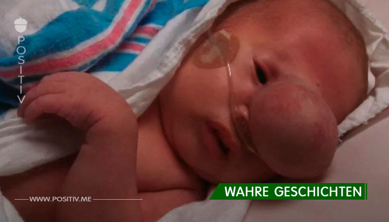 Ärzte entfernen riesigen Sack von Babys Gesicht – was sich darunter versteckt, rührt sie zu Tränen