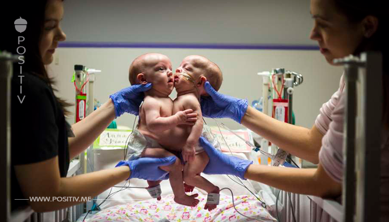 Siamesische Zwillinge nach 7-stündiger Operation getrennt – sehen Sie, wie sie nach der einzigartigen Operation aussehen