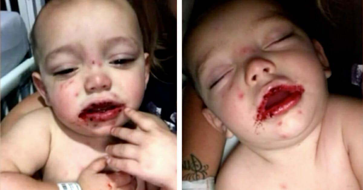 Mutter sieht blutige Blasen im Mund ihres Babys – Diagnose vom Arzt zerstört ihr Leben