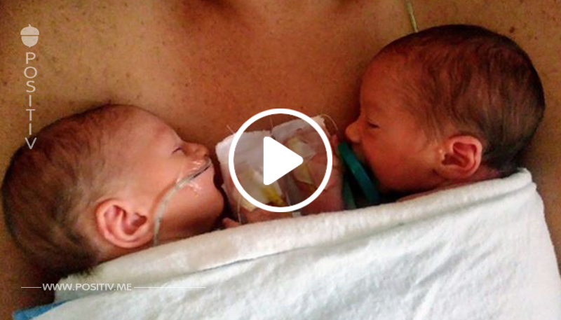 Zwillinge kommen mit seltener Krankheit zur Welt – großer Bruder (4) wird ihr Lebensretter
