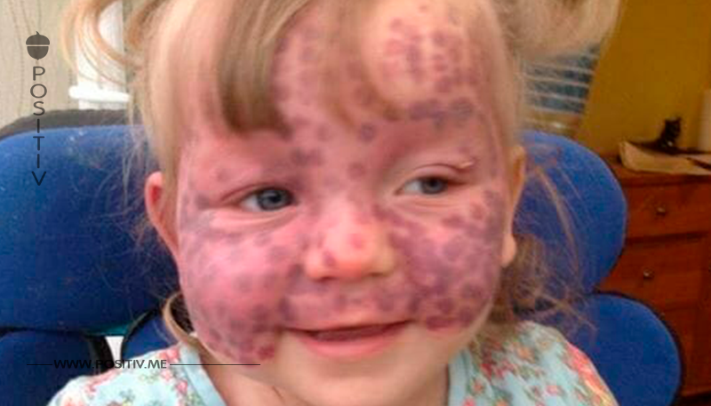 Ärzte sehen normale blaue Flecke – 2 Wochen später kämpft das Mädchen ums Überleben