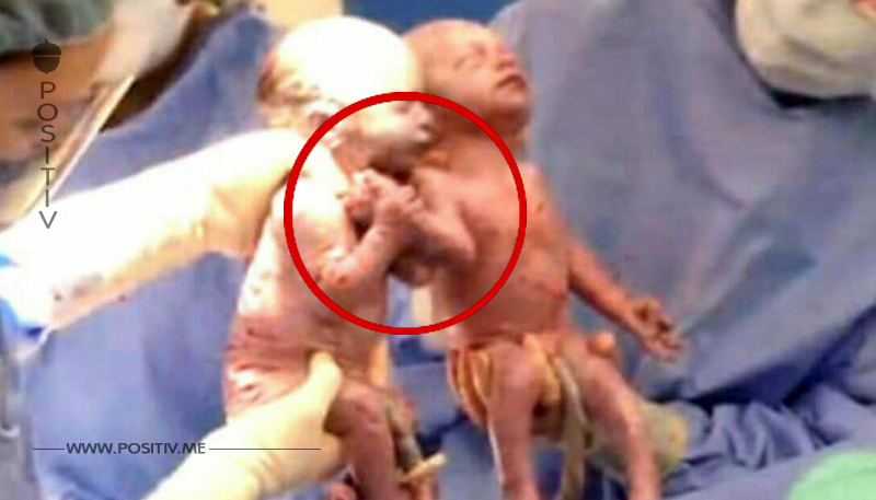 Ärztin erschrickt, als Zwillinge zur Welt kommen: Mutter sieht den Grund