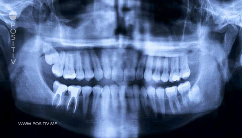 Forscher entdecken Alzheimer-Medikament, das gegen Karies hilft und Zähne repariert