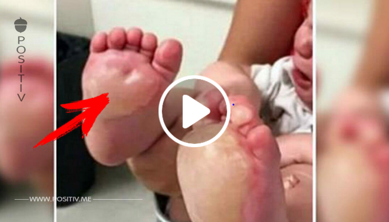 Mutter entdeckt Blasen an Füßen ihres Babys – deckt das schreckliche Geheimnis der Babysitterin auf