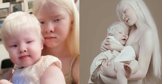 14 atemberaubende Fotos von Albino-Schwestern