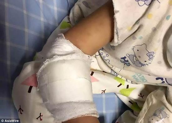 Arm von 4-jähriger Le Le aus China verwächst mit Gummiband