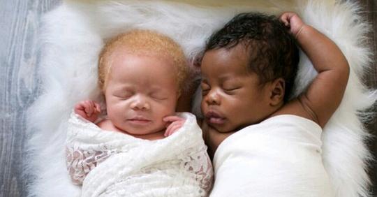 Fotografin bringt Zwillinge zur Welt: ein schwarzes und ein weißes – und macht erstaunliche Fotos von Albino Tochter