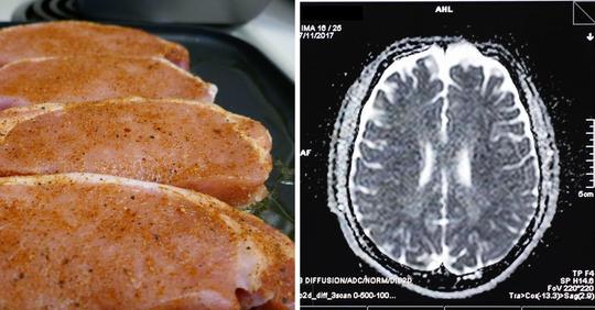 Teenager hat Krämpfe und stirbt, nachdem Ärzte Bandwurmeier im Gehirn entdecken, die durch den Verzehr von Schweinefleisch aufgenommen wurden