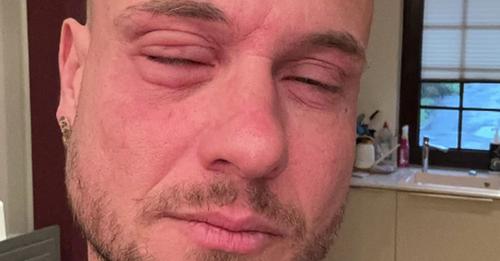 Dickes Auge: Eric Sindermann hat eine allergische Reaktion!