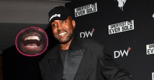 Skurril? Kanye West lässt Zähne entfernen für Titanprothese!
